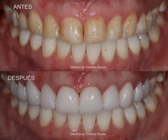 قبل وبعد زراعة الأسنان All-on-6 في Dentica by Cristina Suaza، نتيجة استعادة الابتسامة