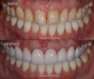 قبل وبعد زراعة الأسنان All-on-6 في Dentica by Cristina Suaza، نتيجة استعادة الابتسامة