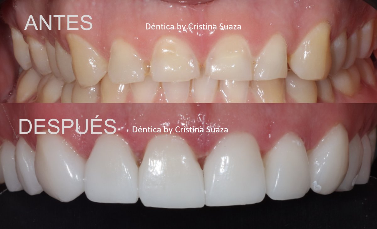 نتيجة قبل وبعد زراعة الأسنان All-on-6 في Dentica by Cristina Suaza، استعادة الابتسامة