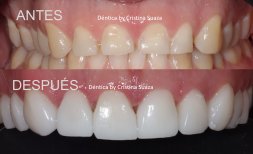 نتيجة قبل وبعد زراعة الأسنان All-on-6 في Dentica by Cristina Suaza، استعادة الابتسامة