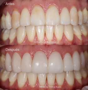 نتائج قبل وبعد قشور الأسنان في Dentica by Cristina Suaza، تحول الابتسامة