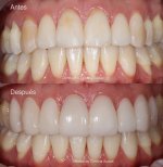 نتائج قبل وبعد قشور الأسنان في Dentica by Cristina Suaza، تحول الابتسامة