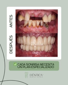 نتائج قبل وبعد تجميل الابتسامة في Dentica by Cristina Suaza، ترميم أسنان كامل