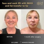Facelift and neck lift with SMAS and lip fat transfer results at ID Clinic Bangkok