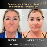 Before and after facelift and neck lift results at ID Clinic Bangkok, visible rejuvenation in 14 days