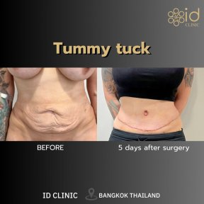 Before and after tummy tuck results at ID Clinic Bangkok, visible abdominal contour improvement