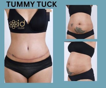 Before and after tummy tuck results at ID Clinic Bangkok, visible abdominal contour improvement