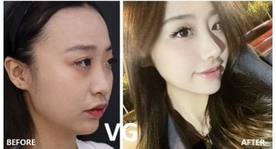 Vorher-nachher-Ergebnis Gesichtskonturierung bei VG Plastic Surgery – verbesserte Symmetrie