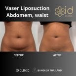 Before and after Vaser abdominal liposuction results at ID Clinic Bangkok, slimmer waistline