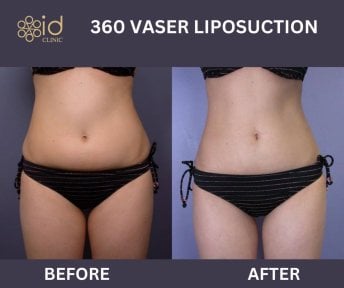 Before and after 360 VASER liposuction results at ID Clinic Bangkok, slimmer abdomen contour