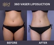 Before and after 360 VASER liposuction results at ID Clinic Bangkok, slimmer abdomen contour