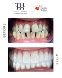 Resultados antes y después de implantes dentales All-on-6 en TH Dental Clinic – sonrisa restaurada