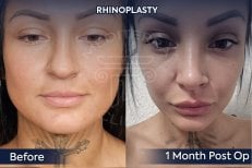 Efekty przed i po rhinoplastyce w Dr. Safa Manav Clinic, 1 miesiąc po operacji
