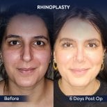 Efekty przed i po rhinoplastyce w Dr. Safa Manav Clinic, widoczna zmiana nosa