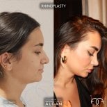 Efekty przed i po rhinoplastyce w klinice Dr. Safa Manav, poprawiony profil nosa