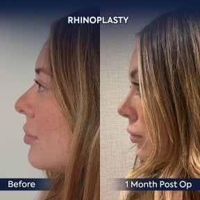 Efekt przed i po rhinoplastyce w Dr. Safa Manav Clinic, korekta nosa po 1 miesiącu