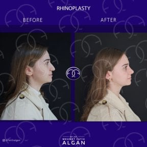Efekty przed i po rhinoplastyce w Dr. Safa Manav Clinic, poprawiony profil nosa