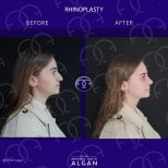 Efekty przed i po rhinoplastyce w Dr. Safa Manav Clinic, poprawiony profil nosa