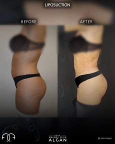 Before and after 360 liposuction results at Dr. Safa Manav Clinic, improved body contour