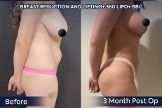 Before and after 360 liposuction, breast lift, and BBL results at Dr. Safa Manav Clinic