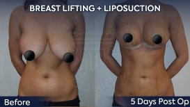 Before and after breast lift with liposuction results at Dr. Safa Manav Clinic, improved contour