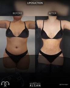 Before and after 360 liposuction results at Dr. Safa Manav Clinic – body contour improvement