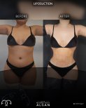 Before and after 360 liposuction results at Dr. Safa Manav Clinic – body contour improvement