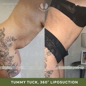 Before and after 360 liposuction and tummy tuck results at Dr. Safa Manav Clinic