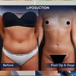 Before and after 360 liposuction results at Dr. Safa Manav Clinic, visible body contouring