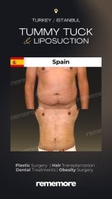 Before and after tummy tuck and liposuction results at Memorial Şişli Hospital, flat abdomen