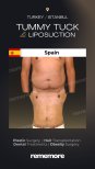 Before and after tummy tuck and liposuction results at Memorial Şişli Hospital, flat abdomen
