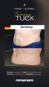 Before and after tummy tuck results at Memorial Şişli Hospital, visible abdominal contouring