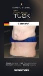 Before and after tummy tuck results at Memorial Şişli Hospital, visible abdominal contouring