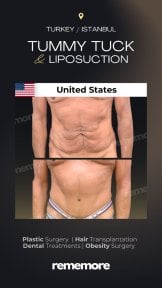 Before and after tummy tuck and liposuction results at Memorial Şişli Hospital, Turkey