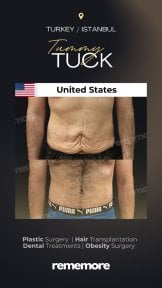 Before and after tummy tuck results at Memorial Şişli Hospital, visible abdominal contouring