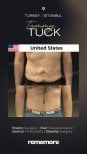 Before and after tummy tuck results at Memorial Şişli Hospital, visible abdominal contouring