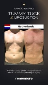 Before and after tummy tuck and liposuction results at Memorial Şişli Hospital, Istanbul