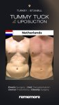 Before and after tummy tuck and liposuction results at Memorial Şişli Hospital, Istanbul