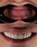 نتائج زراعة الأسنان قبل وبعد في Astra Dental Clinic – استعادة الابتسامة الكاملة