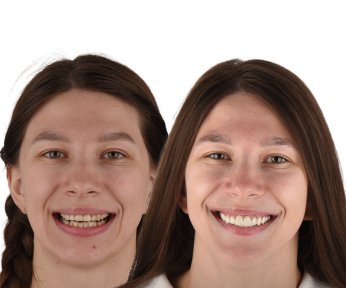before-after photo installation-of-a-veneer