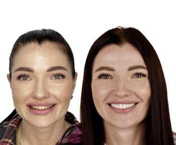 before-after photo installation-of-a-veneer