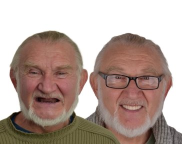 before-after photo all-on-4-dental-implants