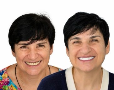 before-after photo all-on-6-dental-implants