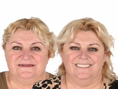 before-after photo all-on-4-dental-implants