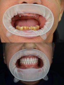 before-after photo all-on-4-dental-implants