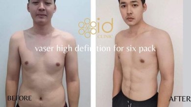 before-after photo abdominal-etching
