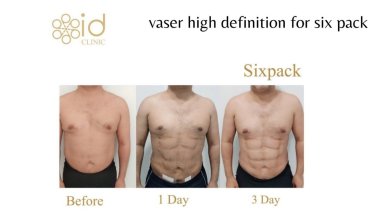 before-after photo abdominal-etching