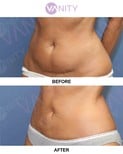 Before and after Vaser liposuction results at Vanity Cosmetic Surgery Center, abdomen contouring