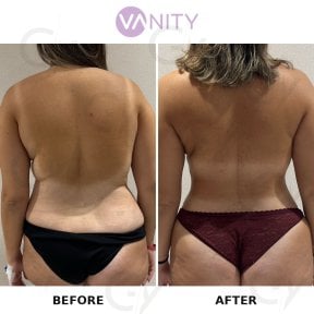 Before and after Vaser liposuction results at Vanity Cosmetic Surgery Center, improved back contour