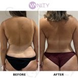 Before and after Vaser liposuction results at Vanity Cosmetic Surgery Center, improved back contour